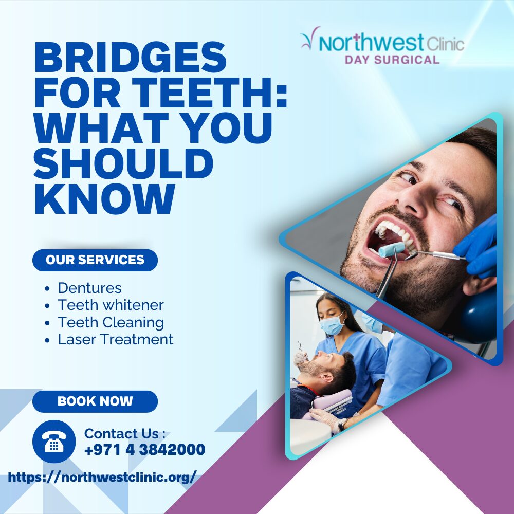 Bridges for Teeth: What You Should Know
